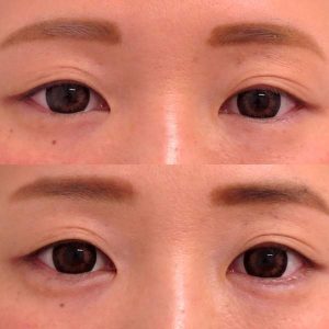 涙袋形成 ヒアルロン酸注入 小顔整形 輪郭整形専門の美容外科 銀座フェイスクリニック