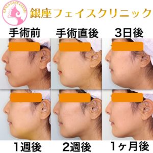 セットバックの症例写真 小顔整形 輪郭整形専門の美容外科 銀座フェイスクリニック