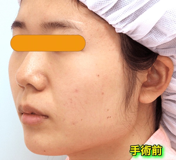 症例写真 エラ削り エラボトックス 小顔整形 輪郭整形専門の美容外科 銀座フェイスクリニック