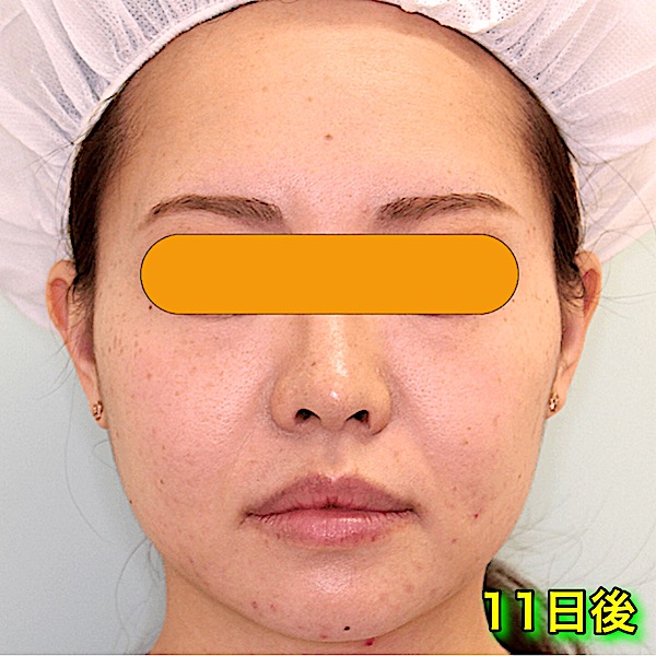 カベリン Kabelline 脂肪溶解注射 小顔整形 輪郭整形専門の美容外科 銀座フェイスクリニック