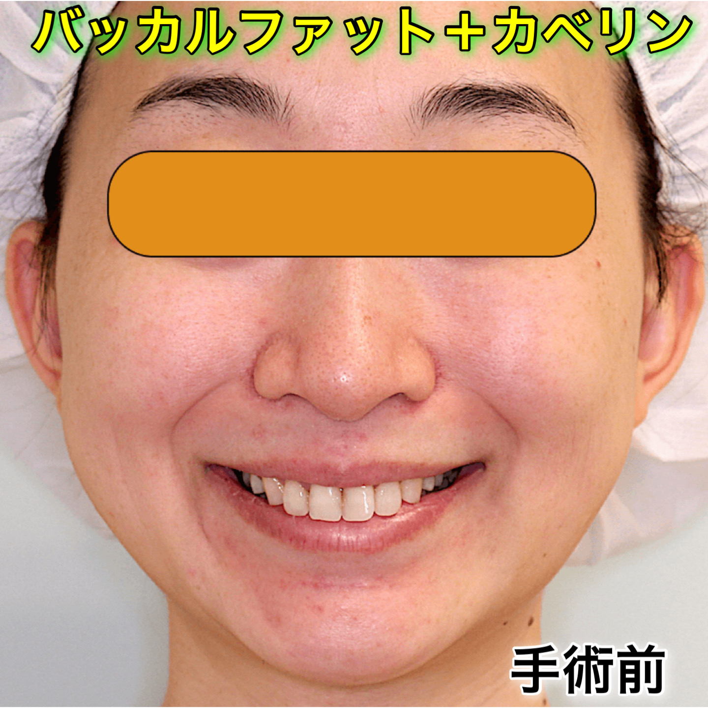 症例写真 バッカルファット除去 カベリン注射 小顔整形 輪郭整形専門の美容外科 銀座フェイスクリニック