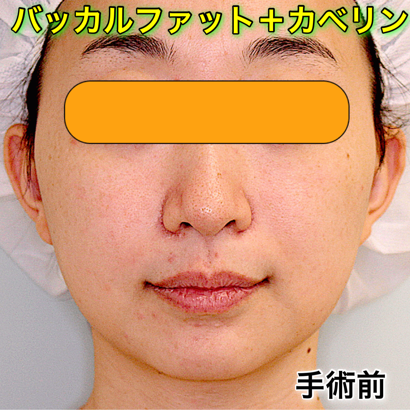 症例写真 バッカルファット除去 カベリン注射 小顔整形 輪郭整形専門の美容外科 銀座フェイスクリニック