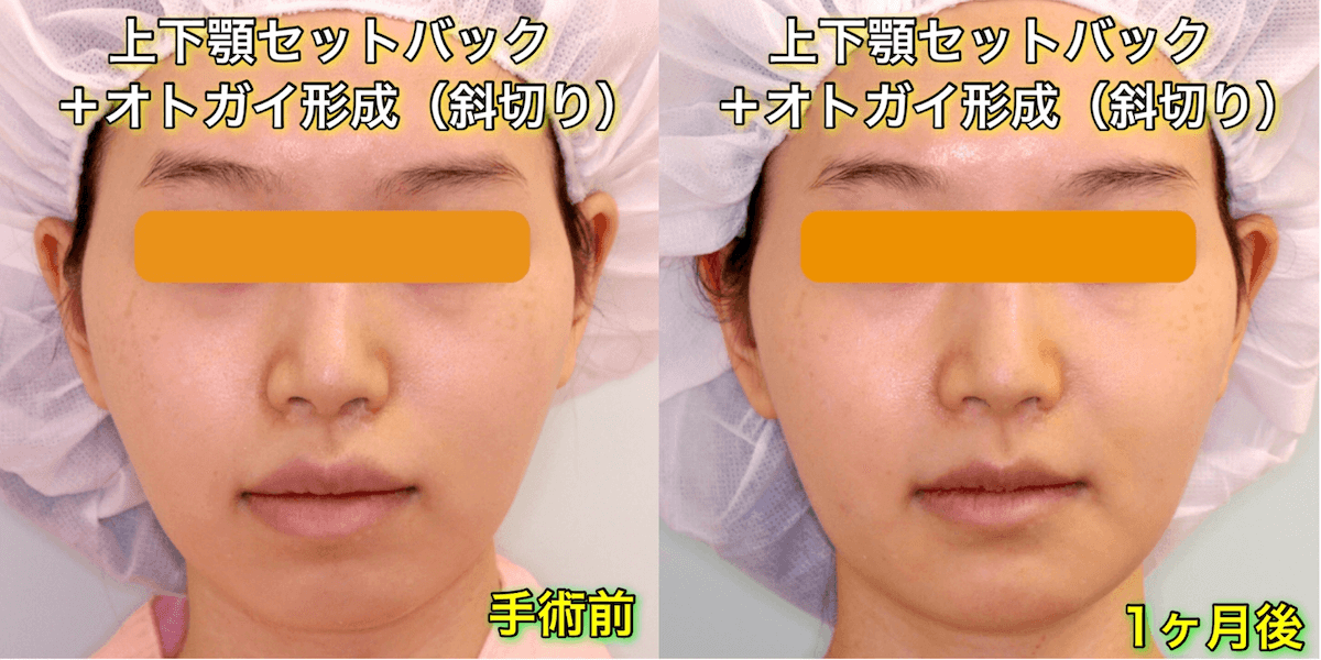 Q セットバックすると 鼻の下 人中 が長く見えますか 小顔整形 輪郭整形専門の美容外科 銀座フェイスクリニック