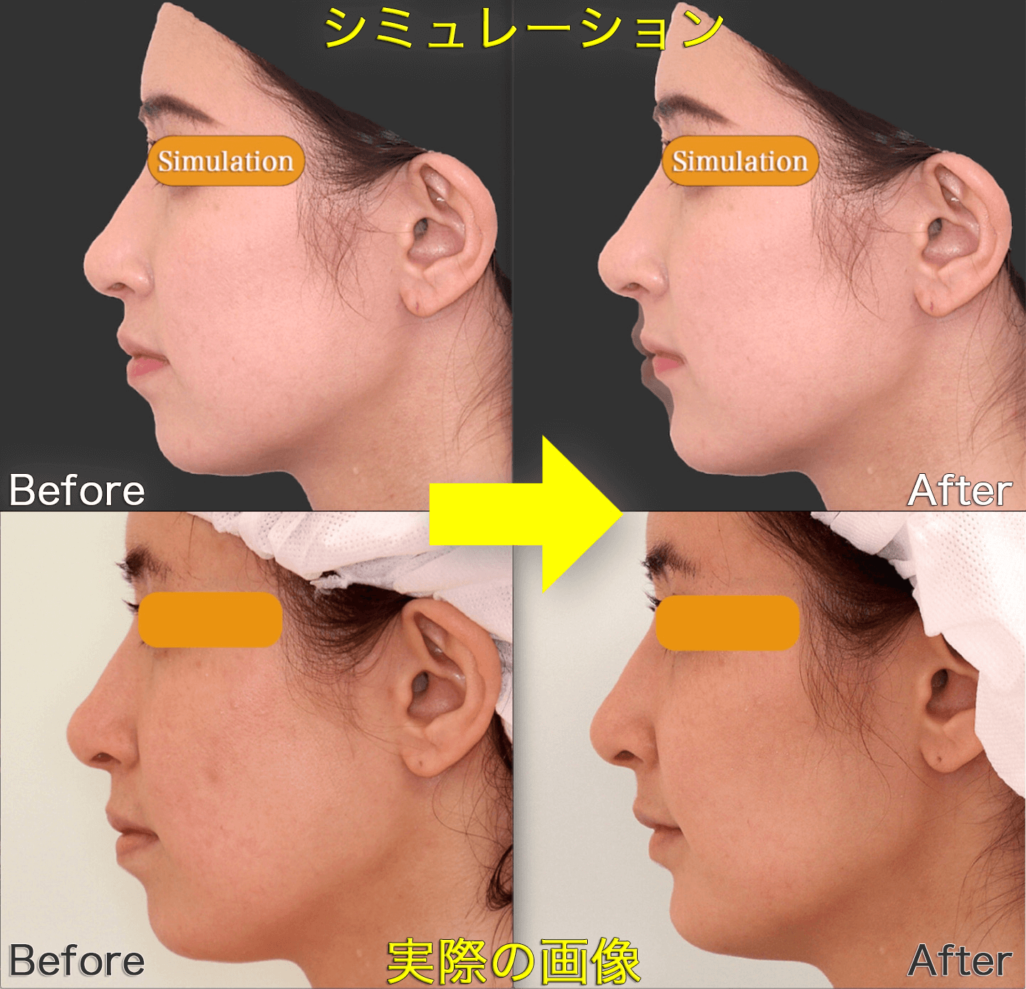 上下顎セットバック 術前シミュレーション 小顔整形 輪郭整形専門の美容外科 銀座フェイスクリニック