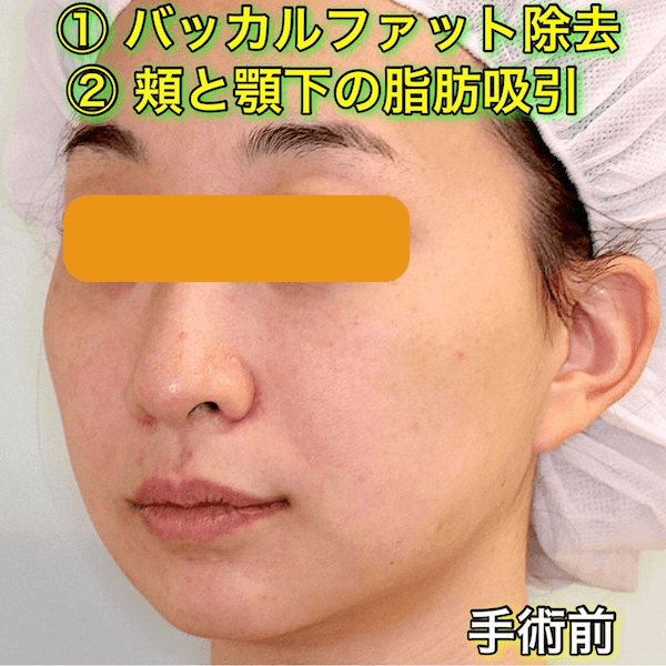 症例写真 バッカルファット 頬と顎下の脂肪吸引 小顔整形 輪郭整形専門の美容外科 銀座フェイスクリニック