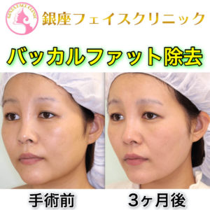 ファット バッカル