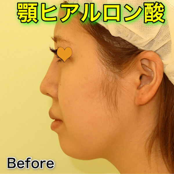 顎ヒアルロン酸 まとめ 小顔整形 輪郭整形専門の美容外科 銀座フェイスクリニック