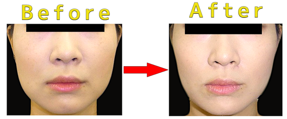 症例写真 バッカルファット除去手術 小顔効果とブルドック顔の予防効果 東京銀座で小顔 輪郭の美容整形するなら 銀座フェイスクリニック 小顔整形 輪郭整形専門の美容外科 銀座フェイスクリニック