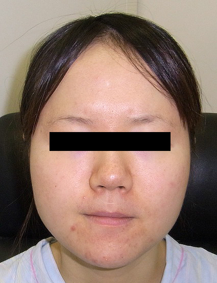 症例写真 頬 顎下の脂肪吸引 小顔整形 輪郭整形専門の美容外科 銀座フェイスクリニック