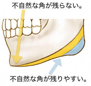 広範囲エラ削り手術のシェーマ