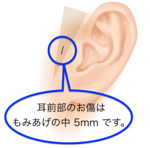 頬骨削り・傷の位置.001