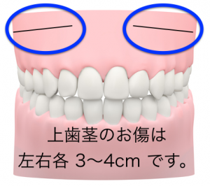 頬骨削り・傷の位置.002