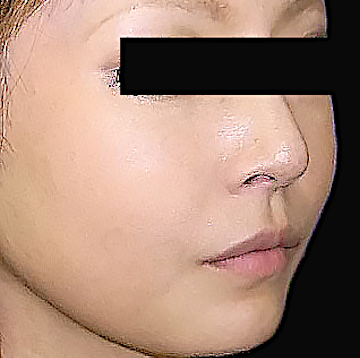 頬骨削りのビフォーアフター