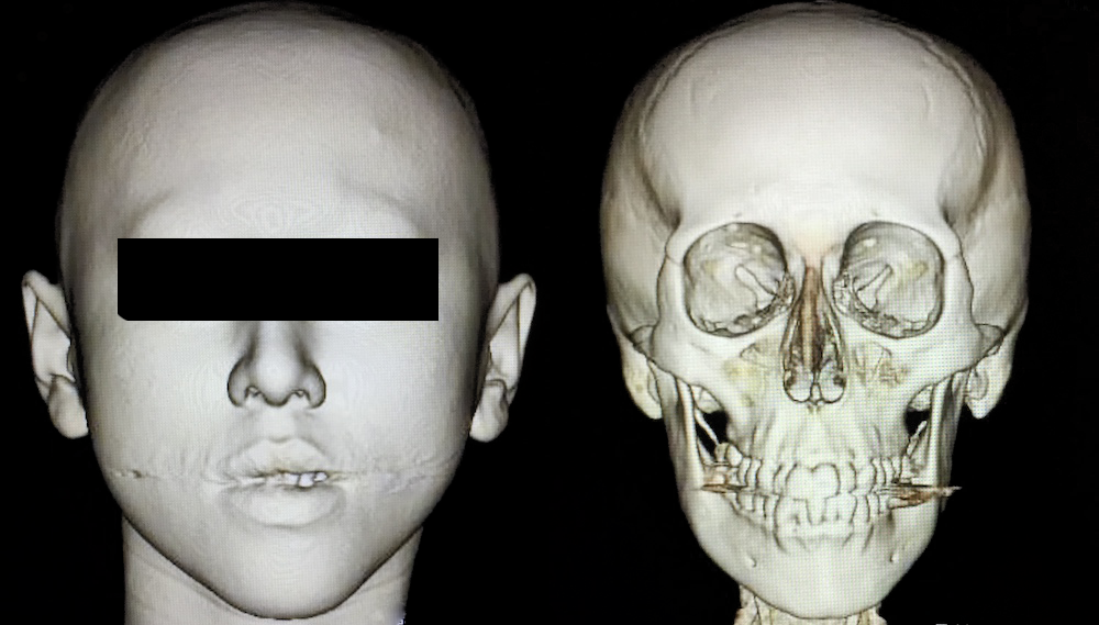 頭蓋顔面骨CT・3D骨格模型・血液検査｜骨切り・骨削り手術の術前