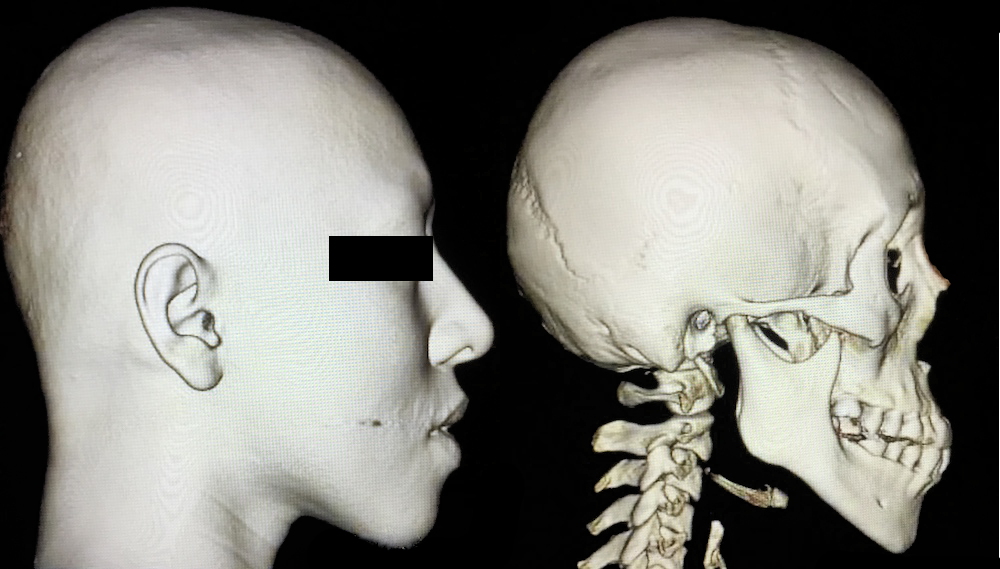 頭蓋顔面骨ct 3d骨格模型 血液検査 骨切り 骨削り手術の術前検査 小顔整形 輪郭整形専門の美容外科 銀座フェイスクリニック