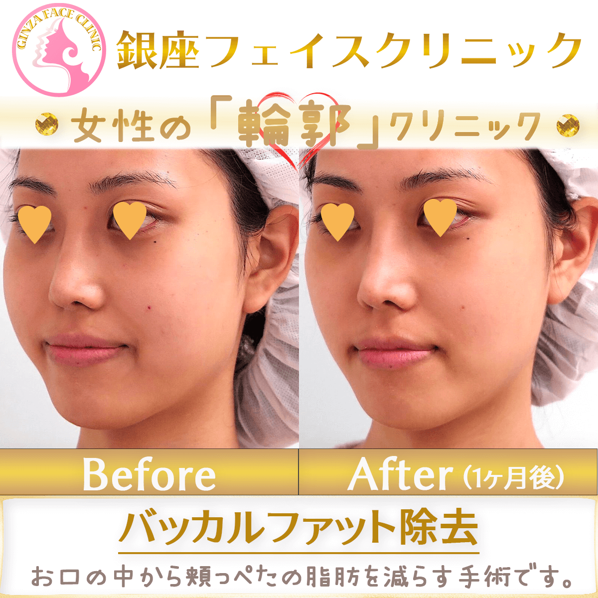 バッカルファット除去手術の症例写真（ビフォーアフター）