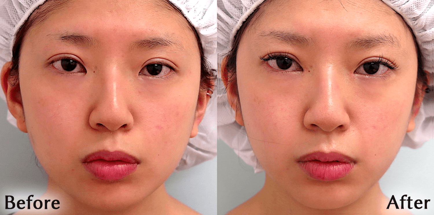 目頭切開BeforeAfter