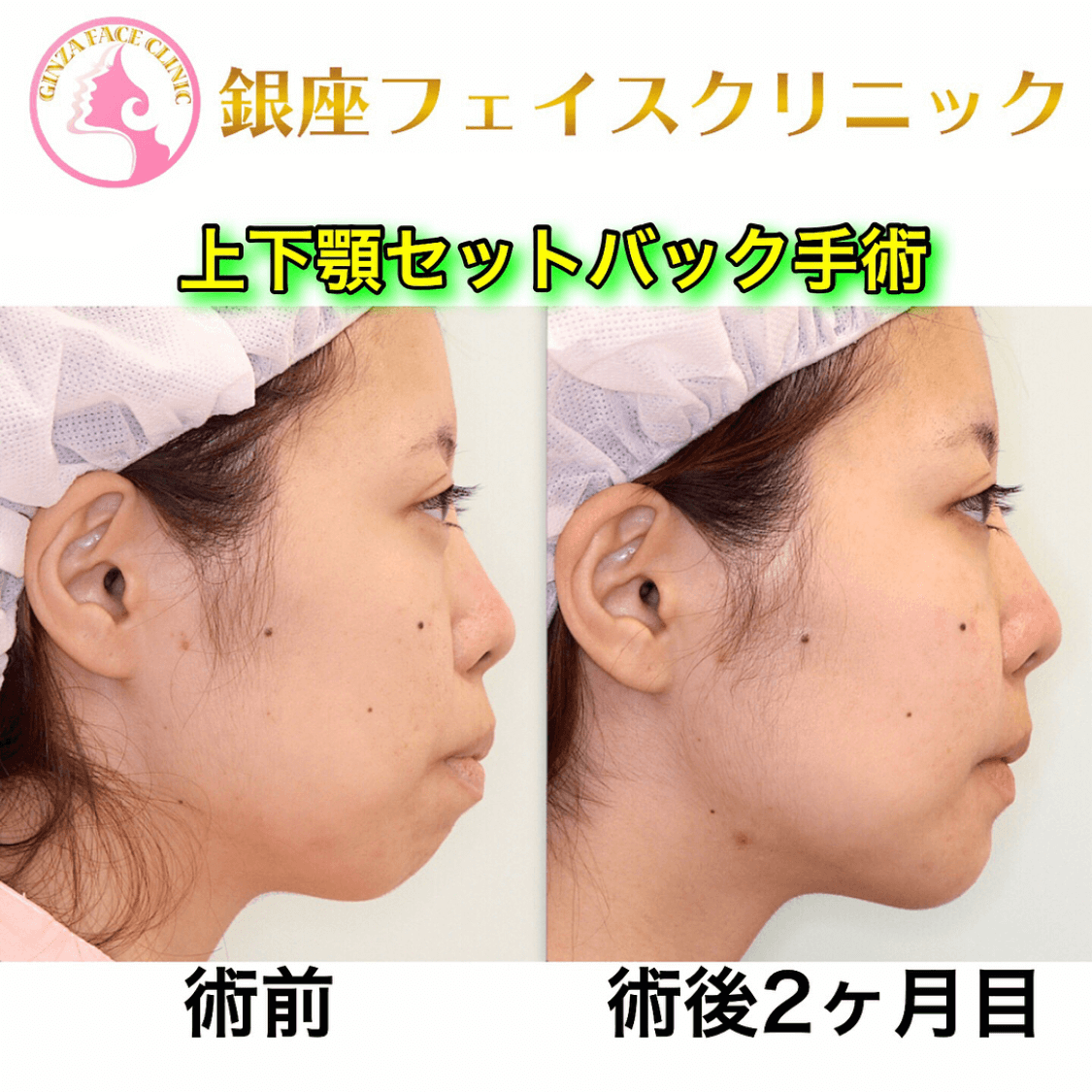 上下顎セットバック症例写真｜左側面｜2ヶ月後