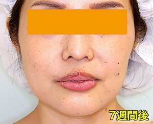 Vライン形成の症例写真4｜After・正面