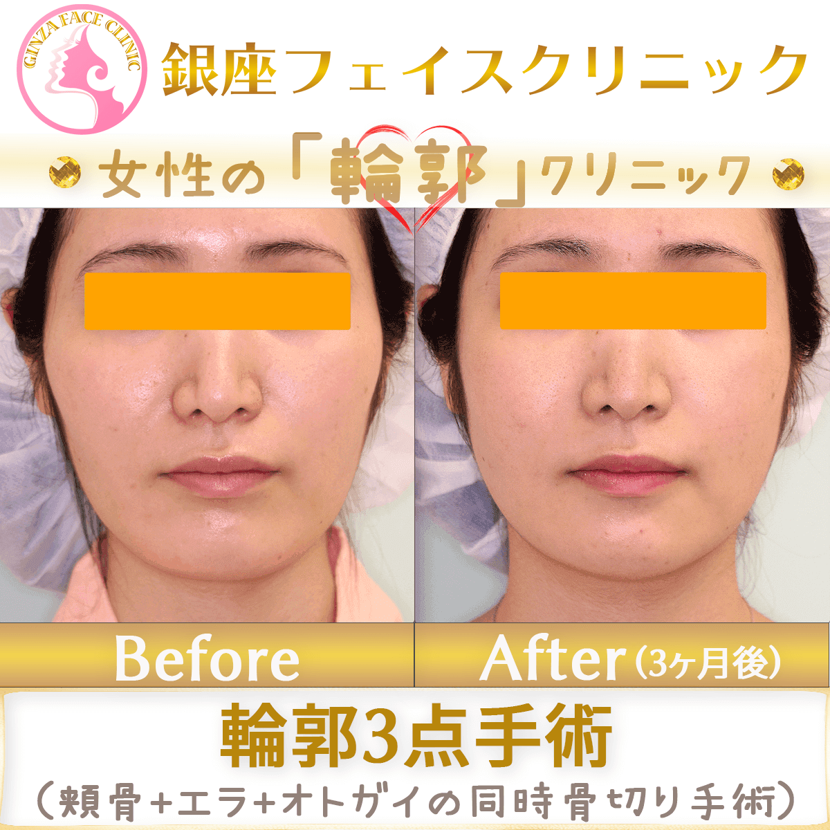 輪郭3点手術のビフォーアフター症例写真