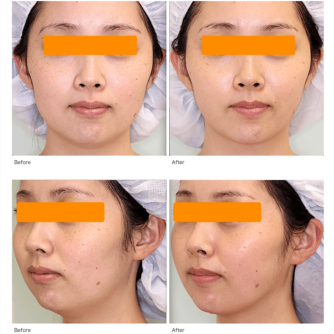 症例写真 顎下と頬の脂肪吸引 小顔整形 輪郭整形専門の美容外科 銀座フェイスクリニック