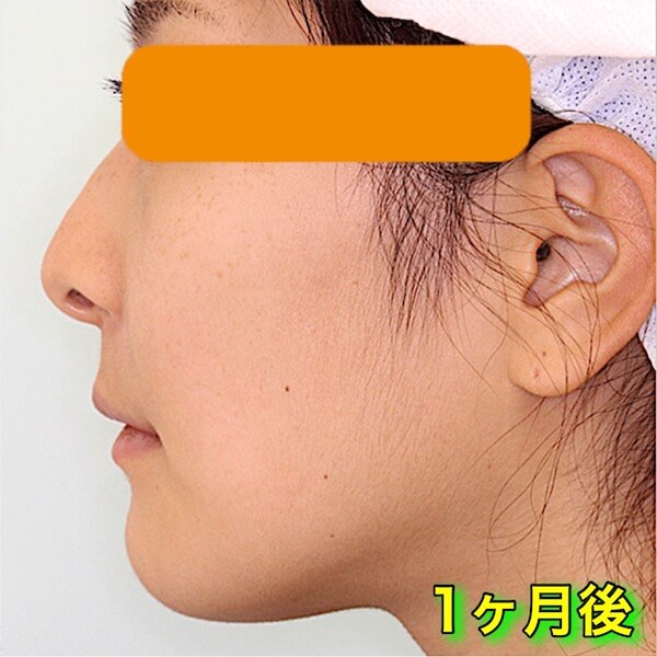 上下顎セットバックのビフォーアフター症例写真（Before After）｜1ヶ月後