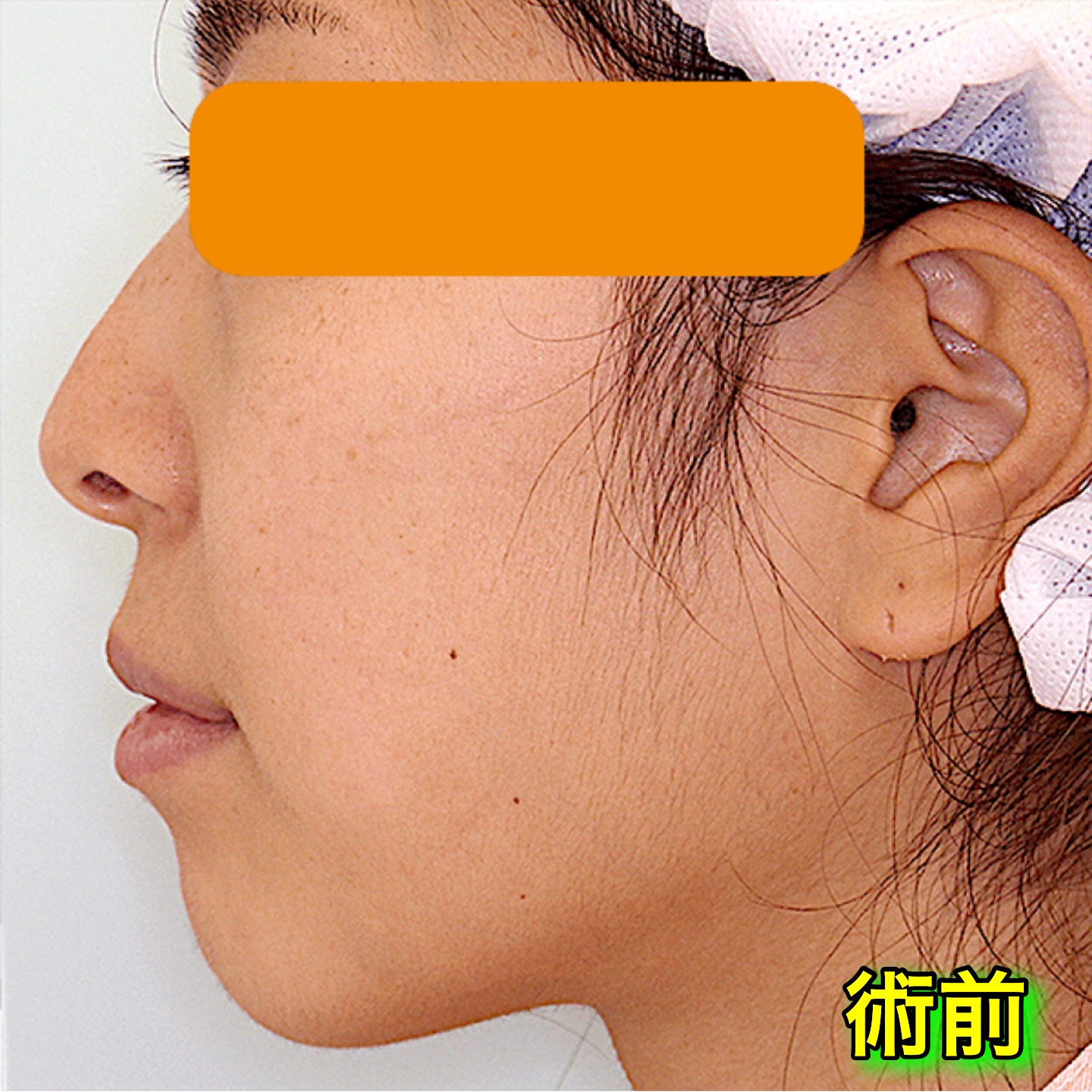 上下顎セットバックのビフォーアフター症例写真（Before After）｜手術前