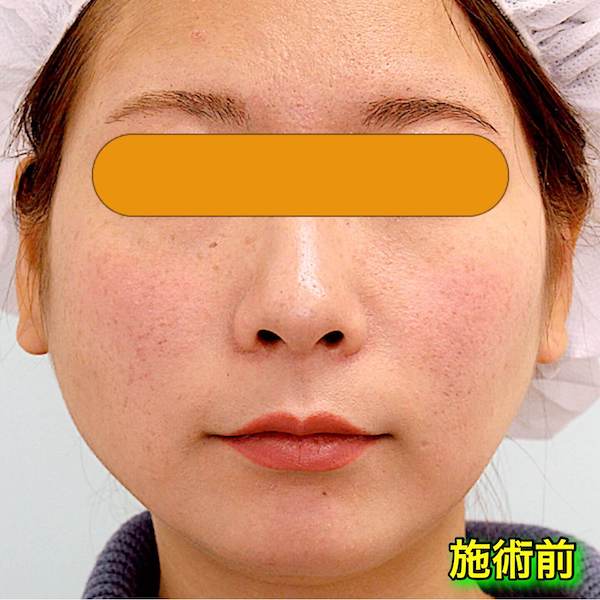 バッカルファット＋エラボトックスのビフォーアフター症例写真｜Before