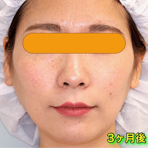 バッカルファット＋エラボトックスのビフォーアフター症例写真｜After