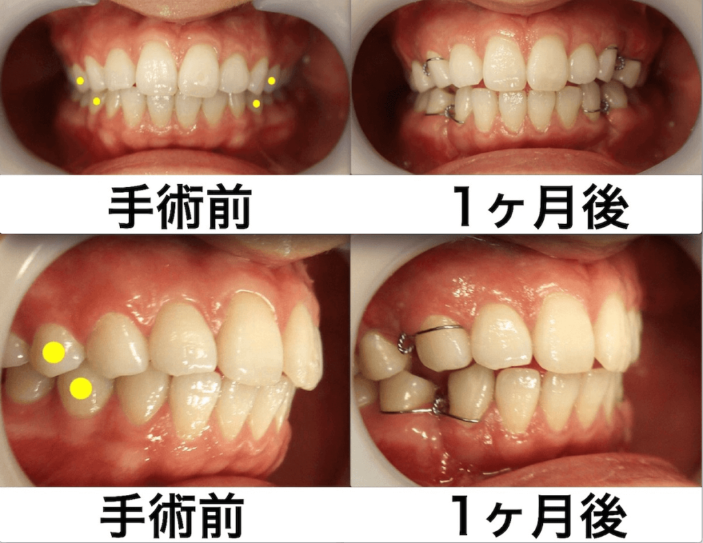 上下顎セットバック＋バッカルファットの症例写真｜口腔内・1ヶ月後