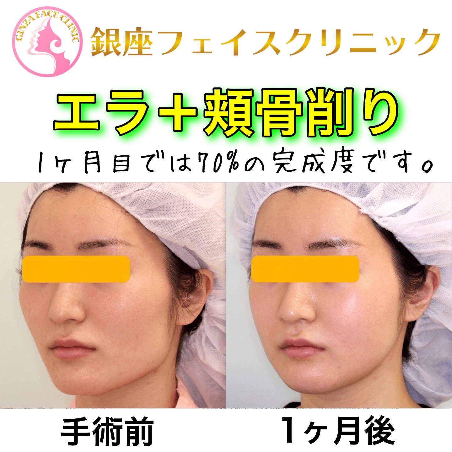 輪郭2点手術（エラ+頬骨）ビフォーアフター2ヶ月後