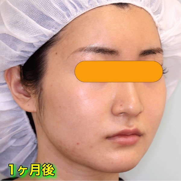 輪郭2点手術｜エラ＋頬骨｜ビフォーアフター（1ヶ月後）