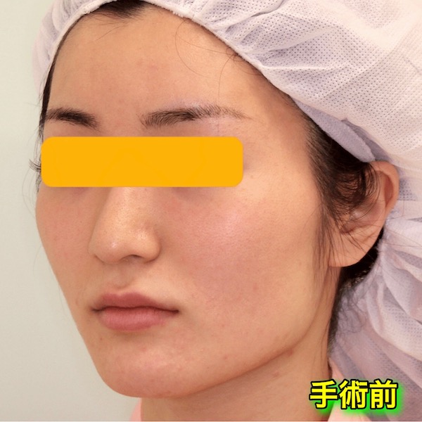 輪郭2点手術｜エラ＋頬骨｜ビフォーアフター（1ヶ月後）