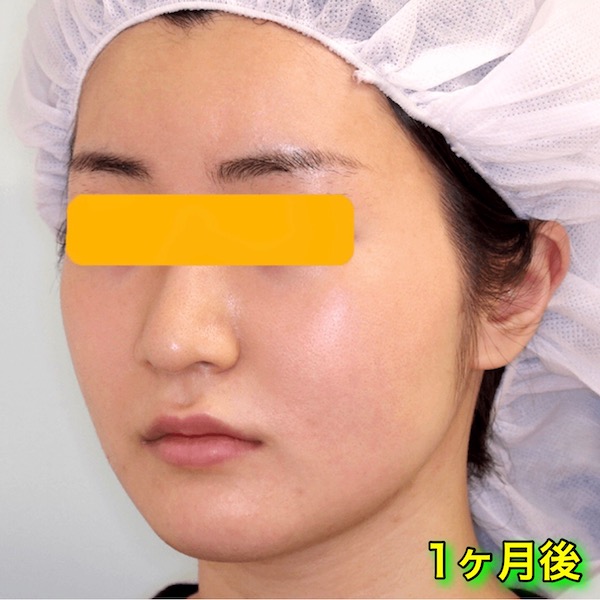 輪郭2点手術｜エラ＋頬骨｜ビフォーアフター（1ヶ月後）