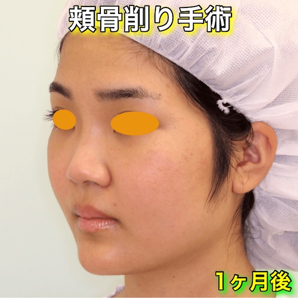 頬骨削り手術のビフォーアフター症例写真（1ヶ月後）