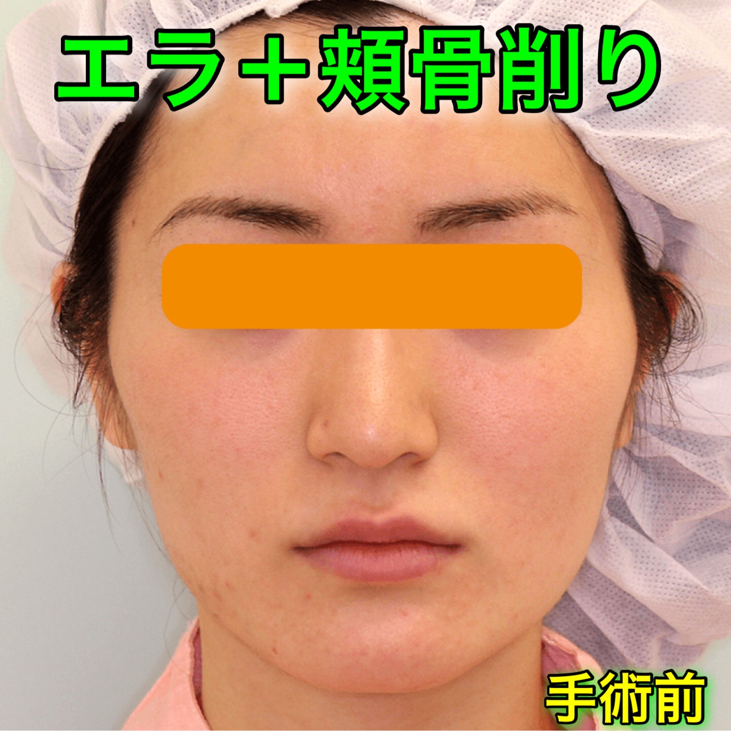 エラ削り＋頬骨削り｜ビフォーアフター症例写真｜手術前・正面