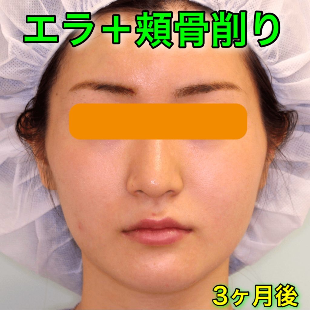 エラ削り＋頬骨削り｜ビフォアフター症例写真｜3ヶ月後・正面