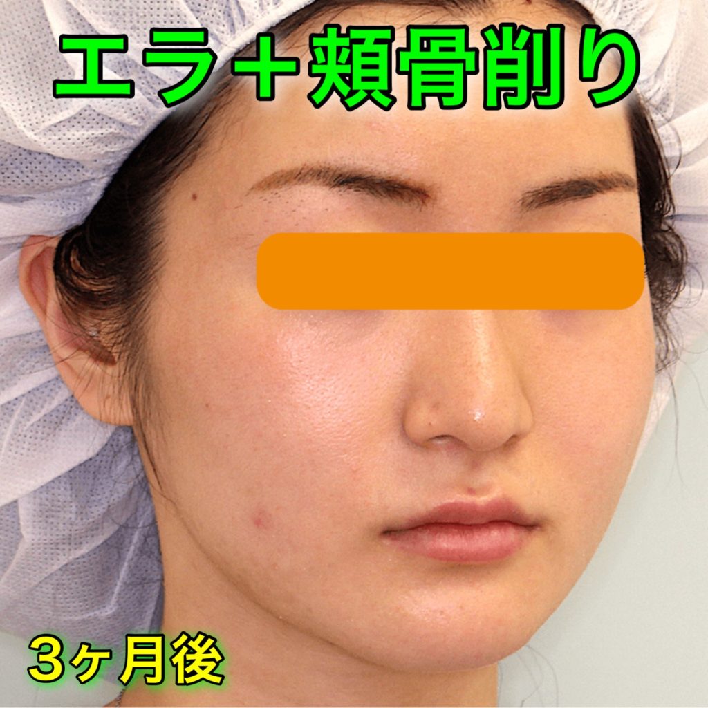 エラ削り＋頬骨削り｜症例写真（BeforeAfter）｜3ヶ月後・斜め