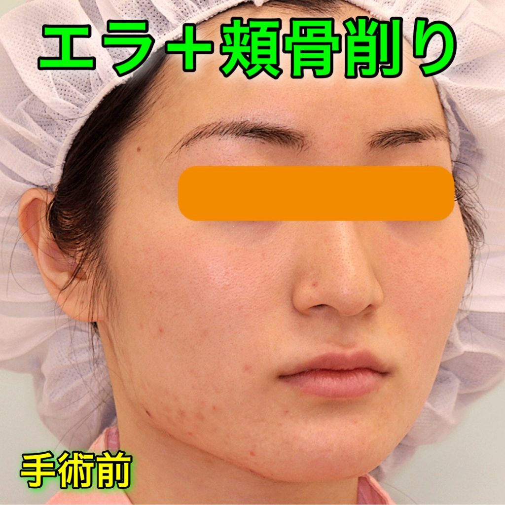 エラ削り＋頬骨削り｜症例写真（BeforeAfter）｜手術前・斜め