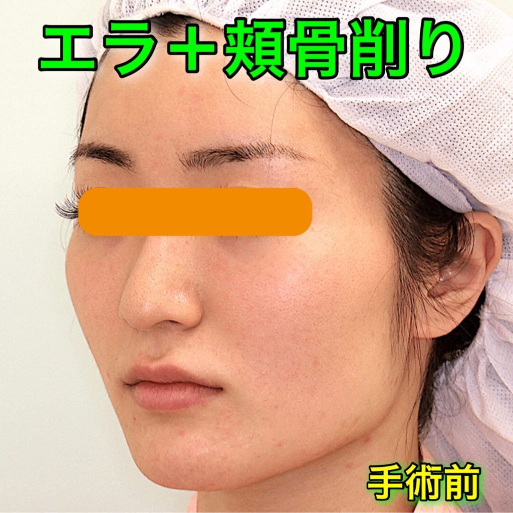 エラ削り＋頬骨削り｜ビフォーアフター症例写真（BeforeAfter）｜手術前・斜め