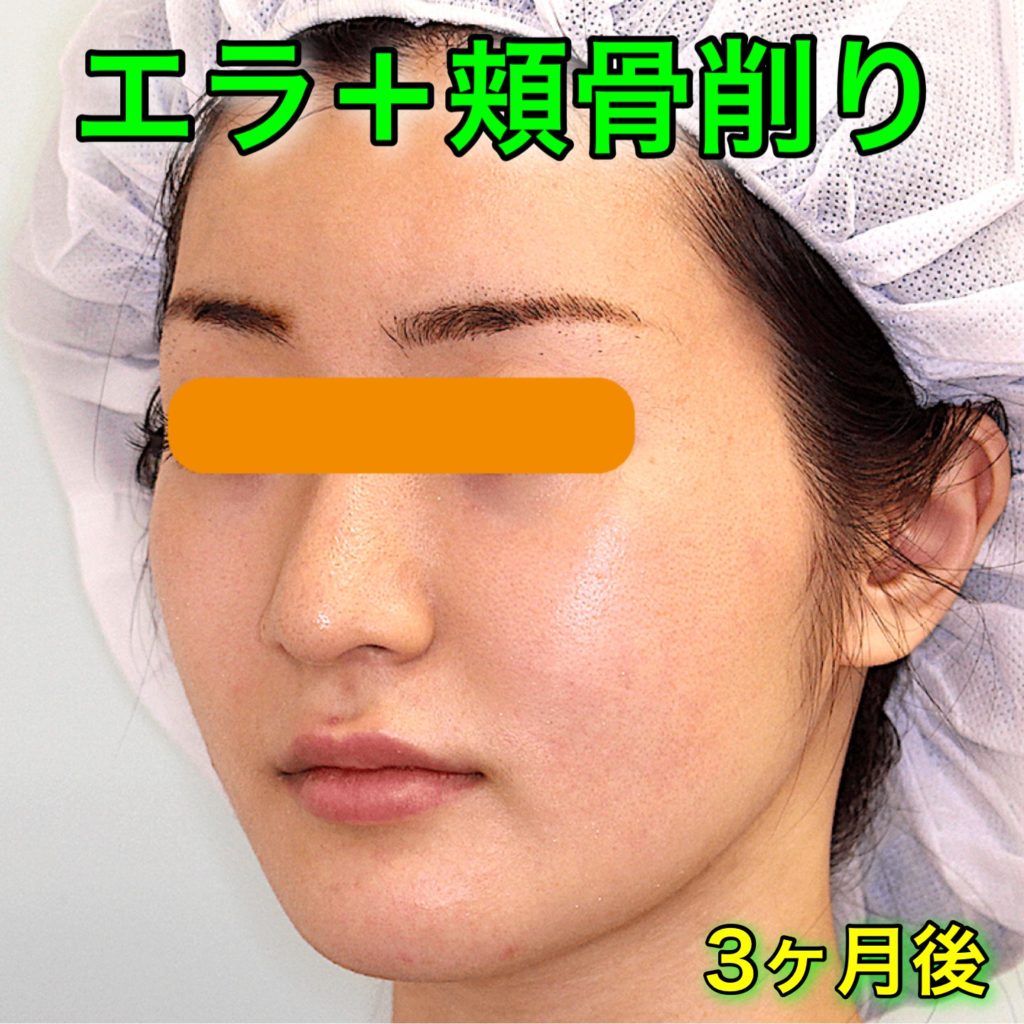 エラ削り＋頬骨削り｜ビフォーアフター症例写真（BeforeAfter）｜3ヶ月後・斜め