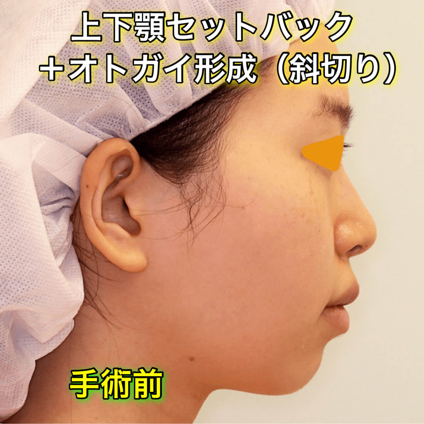 上下顎セットバック+オトガイ形成ののビフォーアフター症例写真