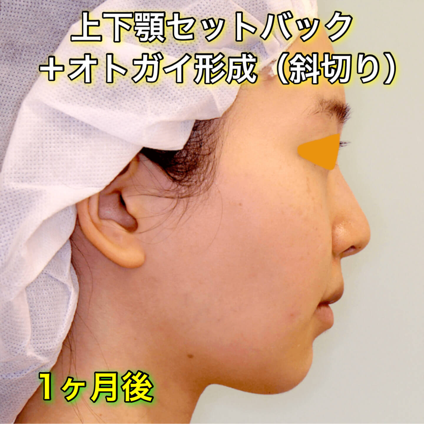 上下顎セットバック+オトガイ形成ののビフォーアフター症例写真