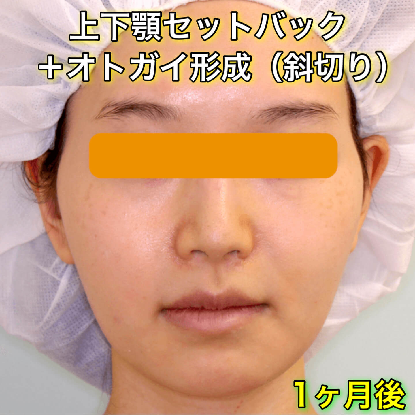 上下顎セットバック+オトガイ形成ののビフォーアフター症例写真