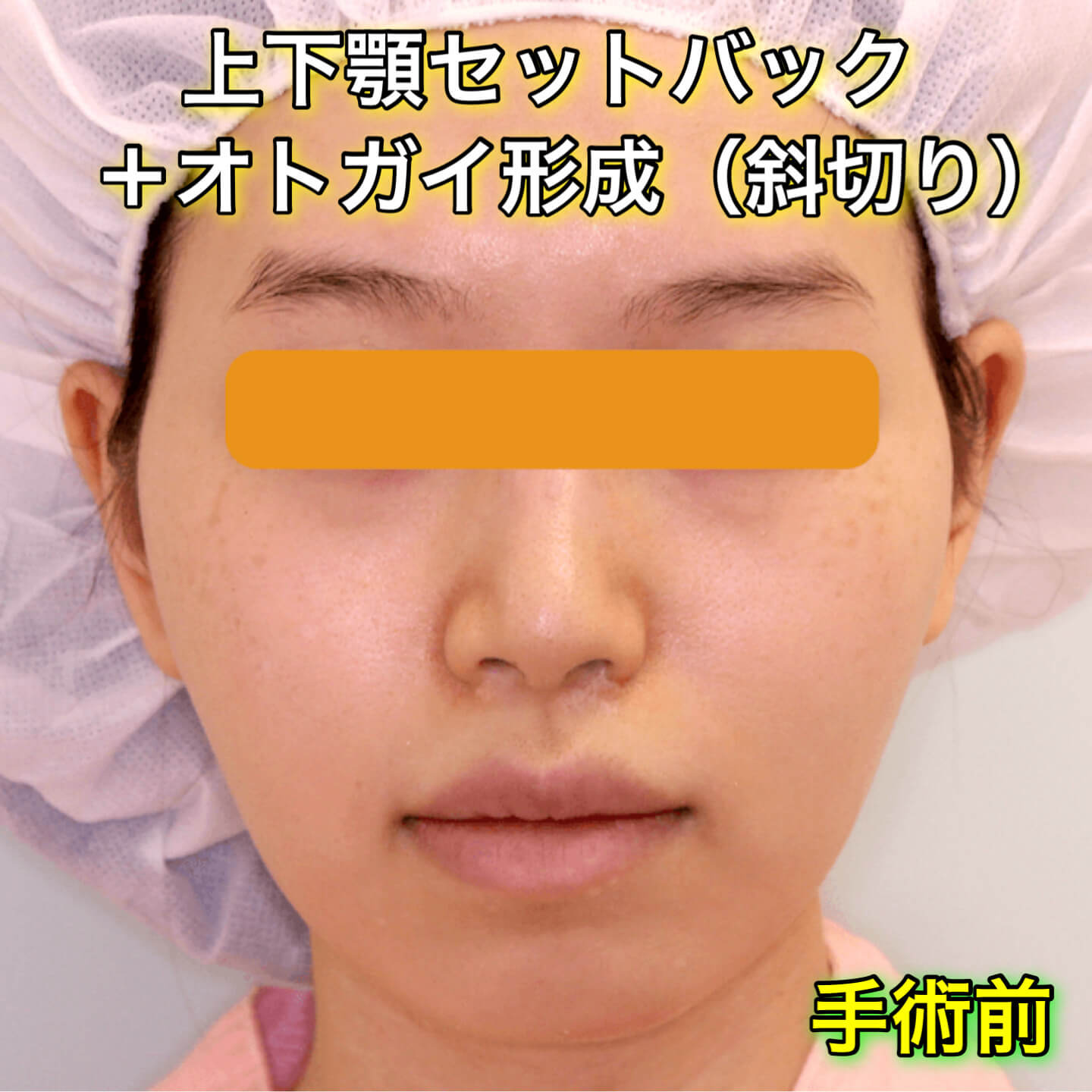 上下顎セットバック+オトガイ形成ののビフォーアフター症例写真
