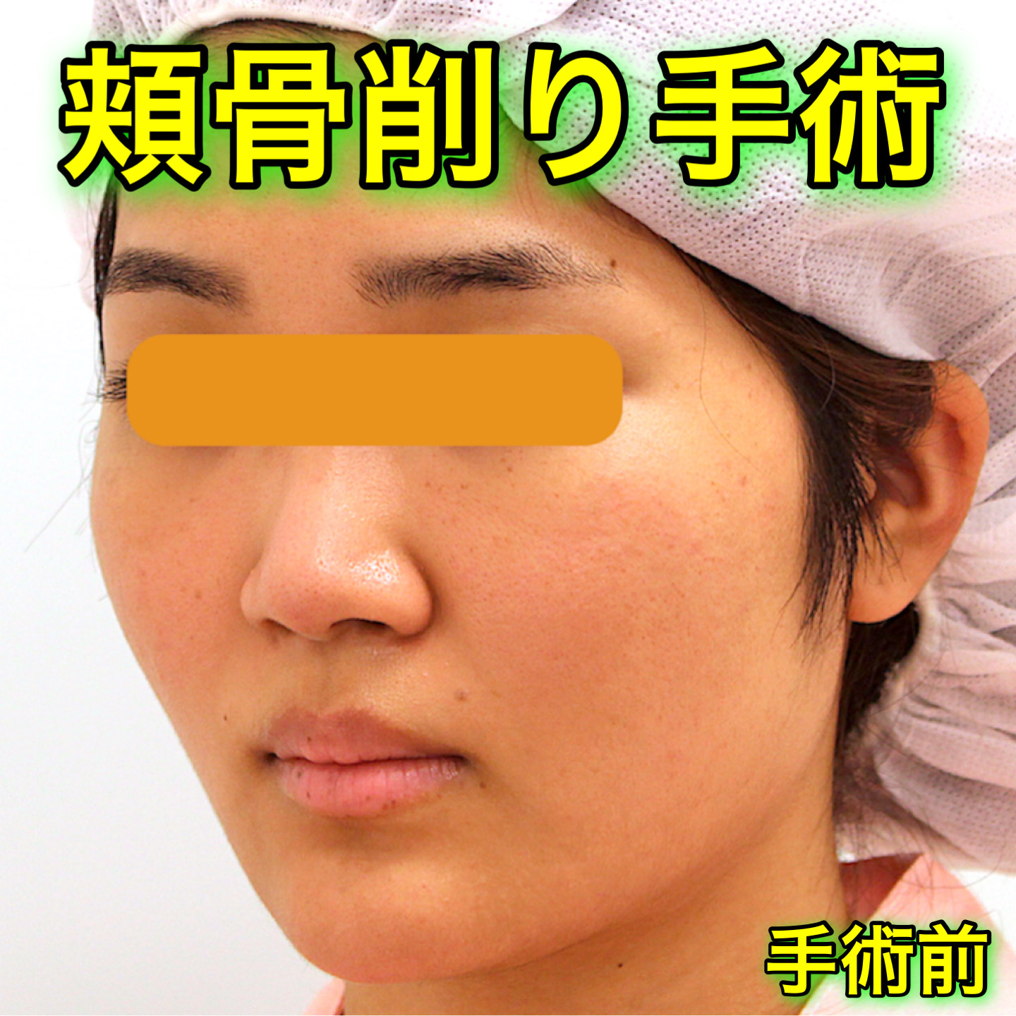 頬骨削り手術の症例写真｜BeforeAfter