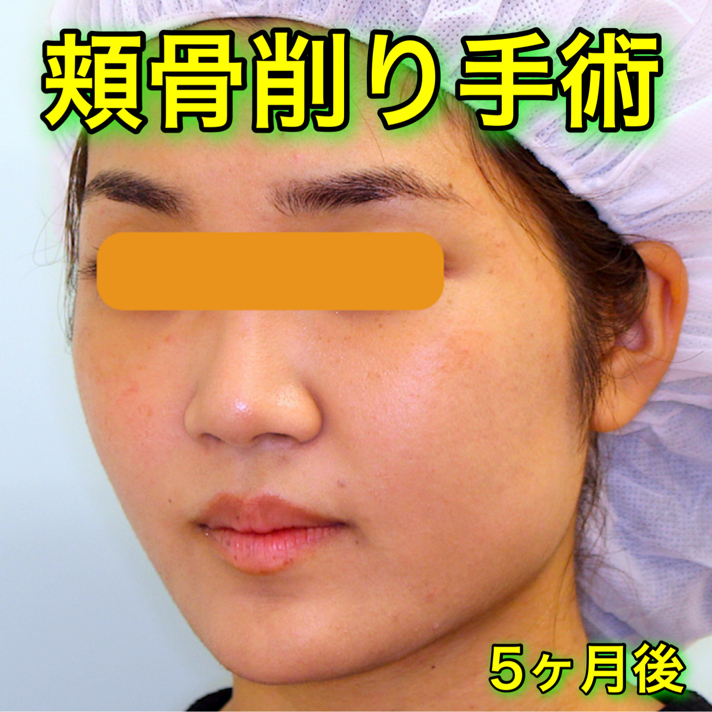 頬骨削り手術の症例写真｜BeforeAfter