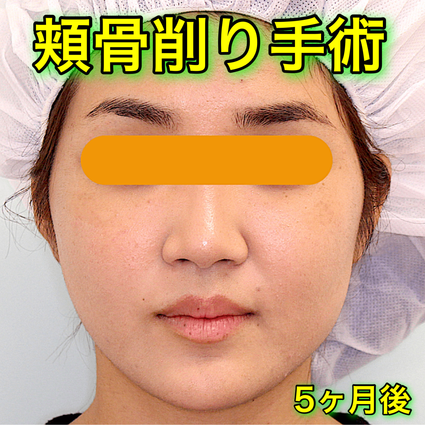 頬骨削り手術の症例写真｜BeforeAfter