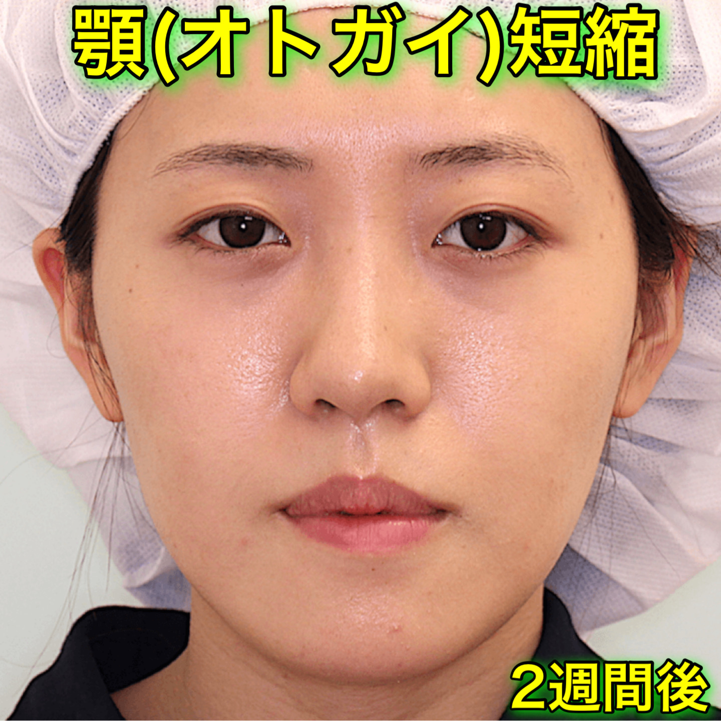 顎削り（オトガイ短縮＆前方移動）｜ビフォーアフター症例写真