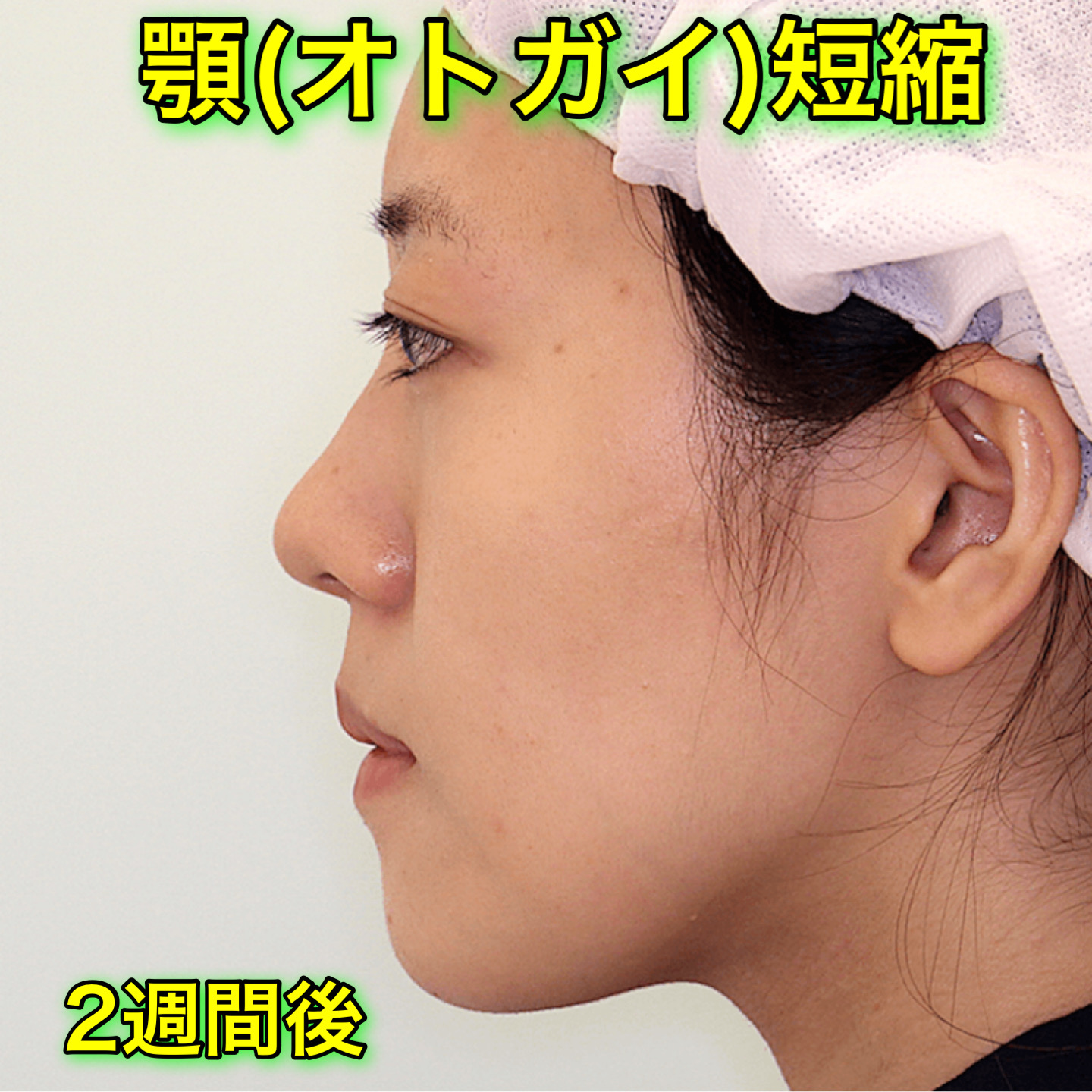 顎削り（オトガイ短縮＆前方移動）｜ビフォーアフター症例写真